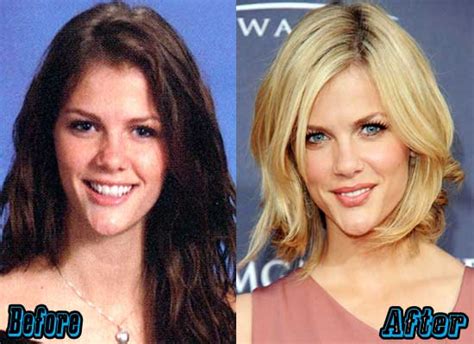 Brooklyn Decker Plastic Surgery Before and After Photos